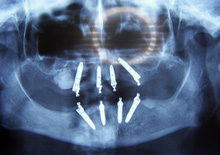 rendgenski prikaz implantata