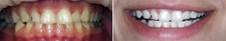 Bleaching of teeth: before and after