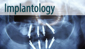 implantologija