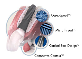 Ask for dental implants