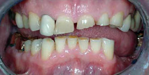 Protect your worn teeth