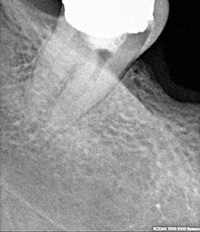 donji desni umnjak prije endodontskog liječenja
