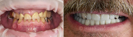 Rehabilitacija zubala porculanskim krunicama prije i poslije
