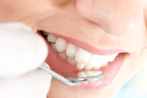 Zubni brošić