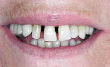 La riabilitazione orale completa realizata con le capsule in porcellana e dentiere con attachi: prima e dopo