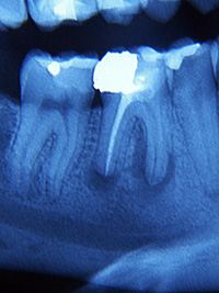 Primo molare inferiore destro con granuloma: prima e dopo la cura canalare
