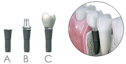 Ugradnja implantata