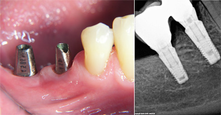 DOPO - I denti sono sostituiti con due impianti e un ponte in metallo-ceramica.