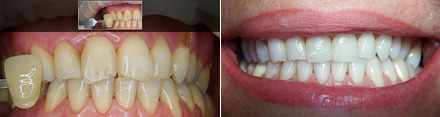 Faccette in ceramica sui denti frontali superiori: prima e dopo