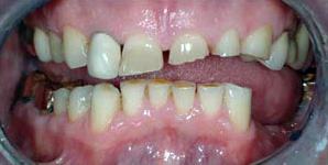 Zaštite vaše abradirane zube
