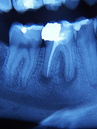 Successful root canal treatment on the lower first right molar with granoloma (before & after)