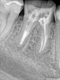 Successful root canal treatment on the lower first right molar with granoloma (before & after)