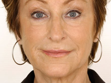 Treatment of wrinkles with Restylene before & after