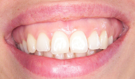 Gummy smile