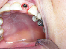 Implant