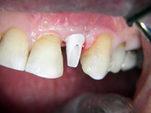 zirconia abutment