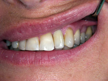 Zirconia porcelain crown