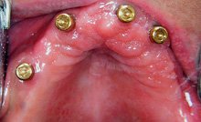 Implants with locators