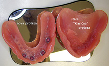 Old and new denture 