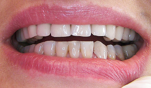 Composite veneer(after)