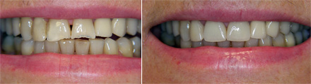 Porcelain veneers before and after