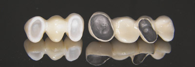 Advantages of zirconia porcelain crowns