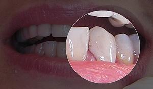 Composite veneer(after)