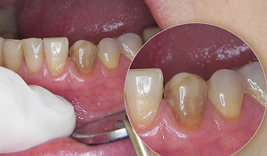  Discoluored lower canine(before)