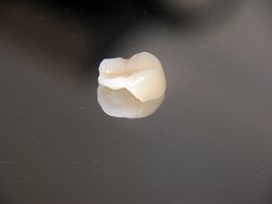 Porcelain inlay