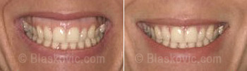 'Gumy smile' -  prije i nakon Botox terapije