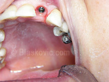 Implantat