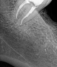 Dente di giudizio prima e dopo la cura canalare